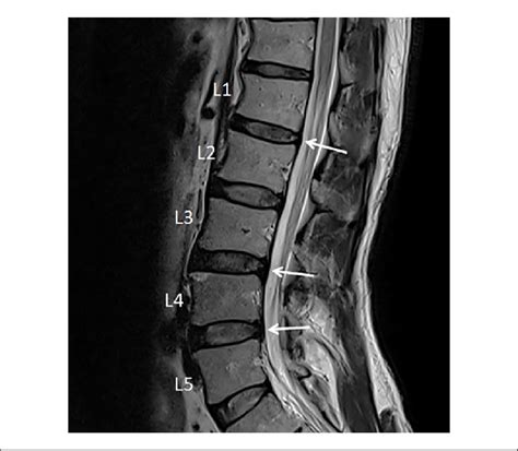 Sagittal T2 Weighted Magnetic Resonance Mr Image Revealed Marginal