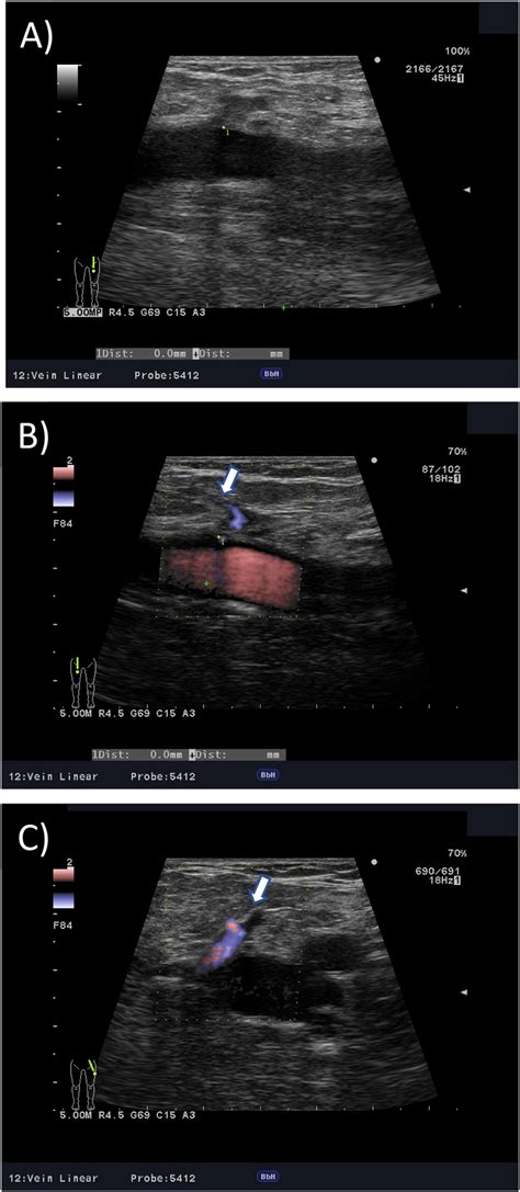 One process leading to anterior accessory saphenous vein recanalization... | Download Scientific ...