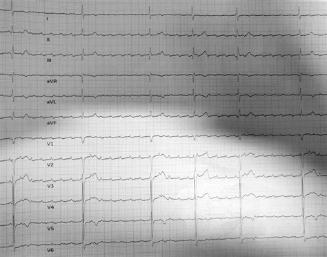 Atrial Flutter With High Degree Av Block Recg