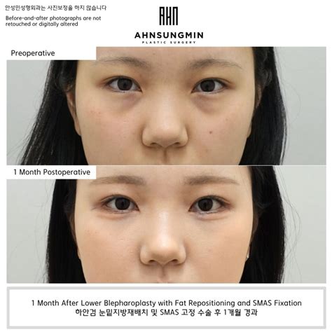 Natural Lower Blepharoplasty Korea | Aegyo-Sal