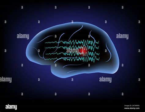 Illustration Of Human Brain And Brain Waves Concept Of Focal Seizure