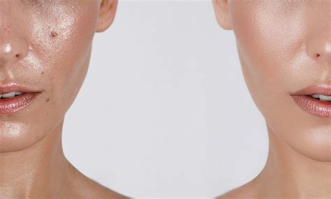 Piel Grasa Tips Para Cuidar La Piel Del Rostro I Bella Piel