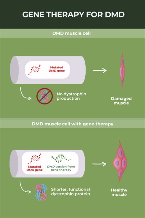 Gene Therapy For Duchenne Muscular Dystrophy Muscular Dystrophy News