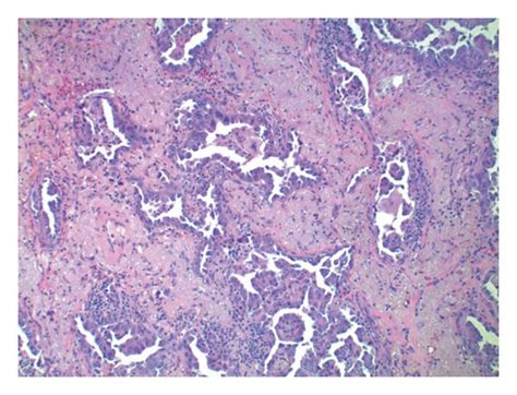 Hematoxylin And Eosin Staining Low Power 100x View Of Adenocarcinoma