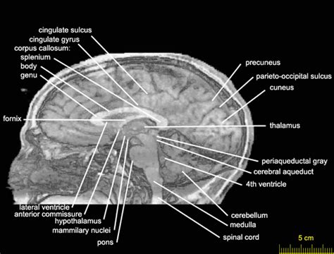 Sagittal Level 0152 As MRI