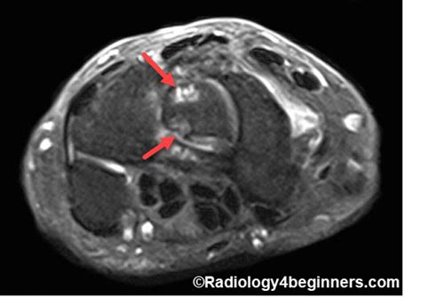 Morbus Kienböck Radiology For Beginners By Dr Samuel Kobba