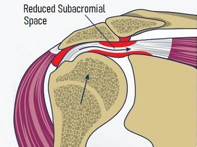 Subacromial Impingement Exercises