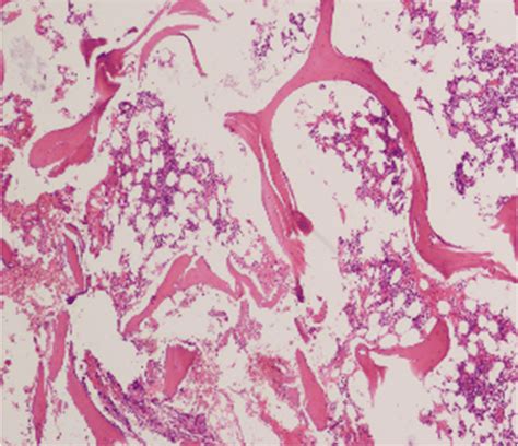 Pathological Section Of Iliac Bone Lesions Illustrated Download