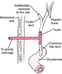 T-tube is inserted to bypass the calculi and allow drainage of bile