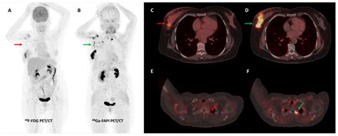 Diagnostics Free Full Text FAPI PET CT ImagingAn Updated Review