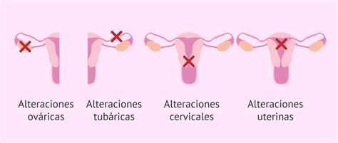 Salpingitis Definición Causas Síntomas Y Tratamiento