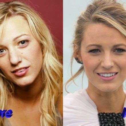 Blake Lively Nose Job: A Slight Change