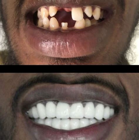 Dental Treatments Before After Curebooking Patients