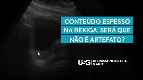 Conteúdo Anecoico Na Bexiga - Bexiga Com Conteúdo Anecóico - BRAINCP