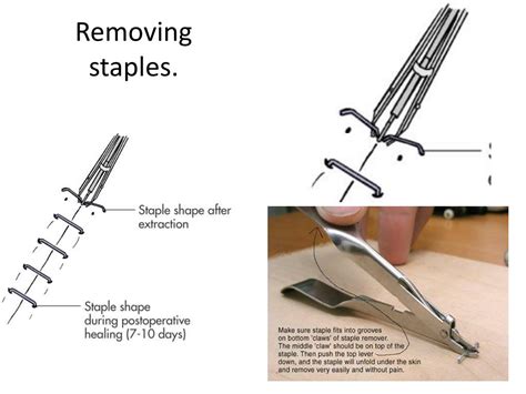 PPT - Surgical Wound Care PowerPoint Presentation, free download - ID ...