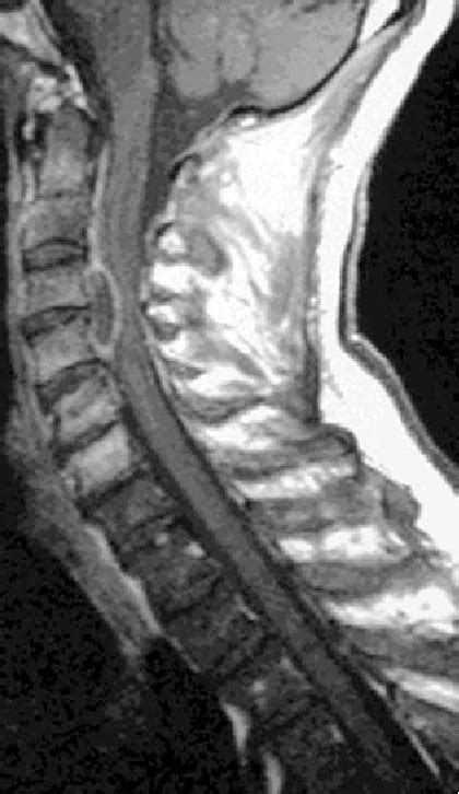 Figure 2 From Pyogenic Cervical Epidural Abscesses Semantic Scholar