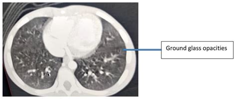 Chest Ct Scan Bilateral Diffuse Ground Glass Opacity Signifying Download Scientific Diagram