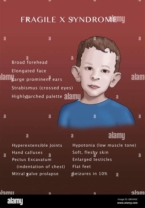 Fragile X Syndrome Symptoms Hi Res Stock Photography And Images Alamy