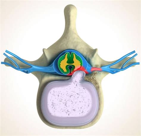 Bulging Disc | Scottsdale, AZ Orthopedic Spine Surgery