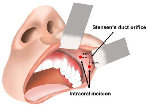 Figure 1 From Surgical Approach To Necrotizing Fasciitis In The Buccal