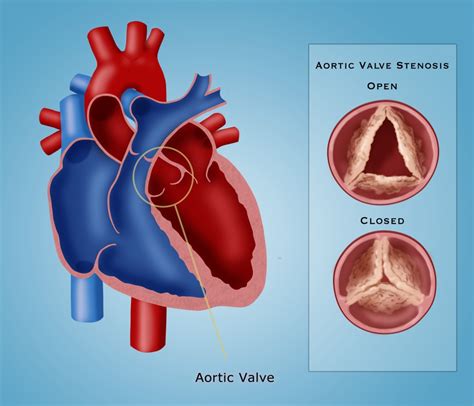 Aortic Valve Stenosis Poster Print By Monica Schroeder Science Source