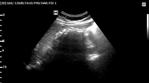 Ultrasound Cases 217 Of 2000 Cholelithiasis And Wes Sign Youtube