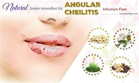 Pin On Angular Cheilitis Remedy Essential Oils