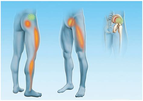 benefits  focused shockwaves   diagnosis