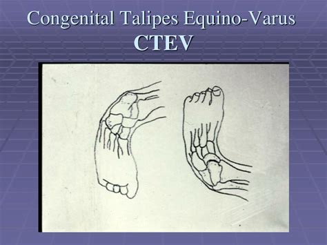 Ppt Congenital Talipes Equino Varus Congenital Clubfoot Powerpoint Presentation Id5730720