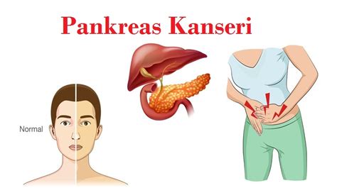 Pankreas Kanseri Belirtileri DrBeckmann