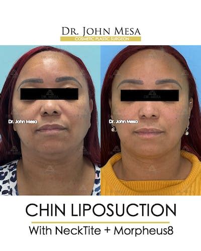 Patient Maicbn68s Mf6axlrnhz2q Chin Liposuction Before And After Photos