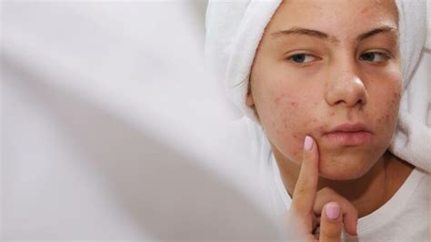 What Are The Best DIY Acne Scars Treatments Cutis Dermatology