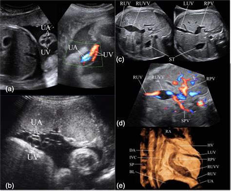 A Four Vessel Umbilical Cord Adc Fetal And Neonatal Edition Images