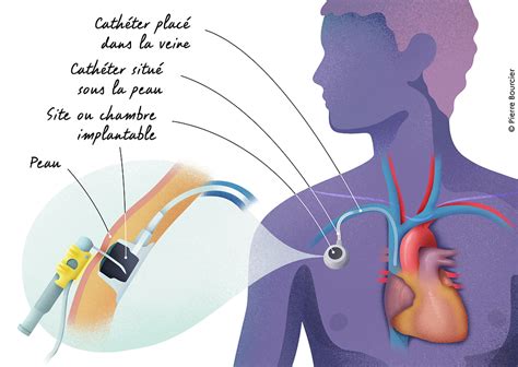 Site implantable pour chimiothérapie Tunisie Prix Pose suivi