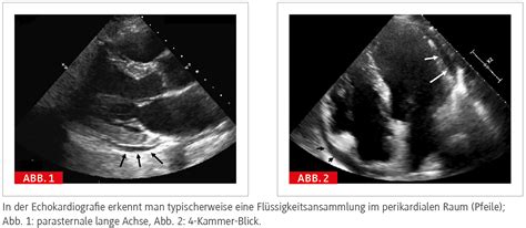 Vielf Ltige Therapieoptionen Bei Perikarditis