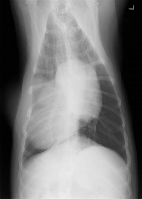 Bone Tumors - Rib — DR. JULIUS M. LIPTAK