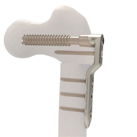 Locking Cannulated Blade Lcb Plate Orthopediatrics