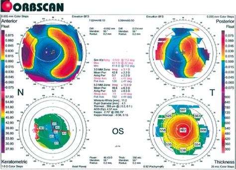 slit scanning corneal topography orbscan  orbtek bausch lomb