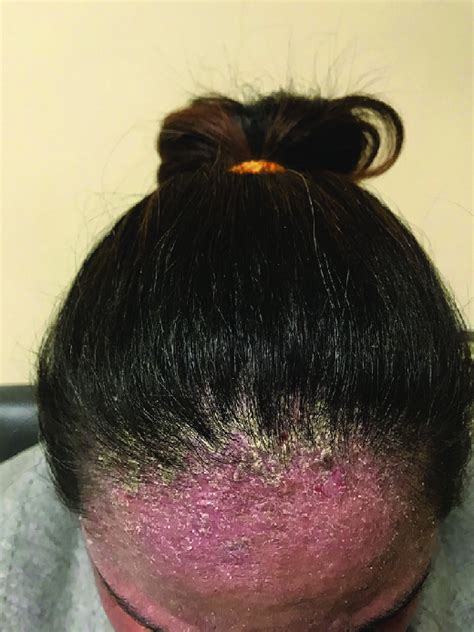 Clinical Photograph Of The Patients Scalp Demonstrating Scaling Of The