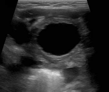 Radiopaedia Case Posterior Urethral Valve Perineal Ultrasound Id