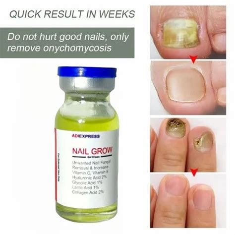 Nail Treatment Repair Gel Feet Care Anti Infection Onychomycosis Fungal ...