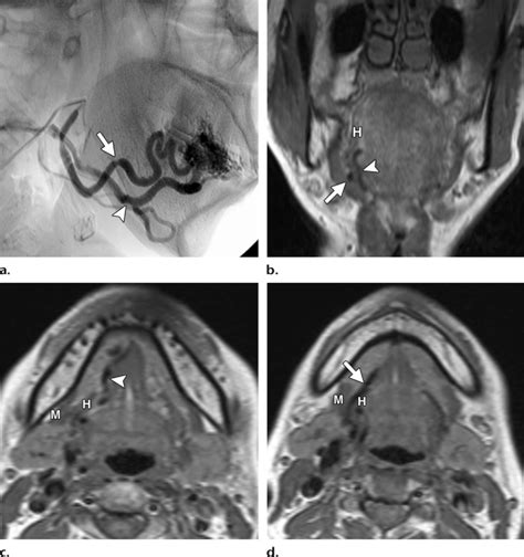 Arteriovenous Malformation At The Inferior Surface Of The Right Side Of