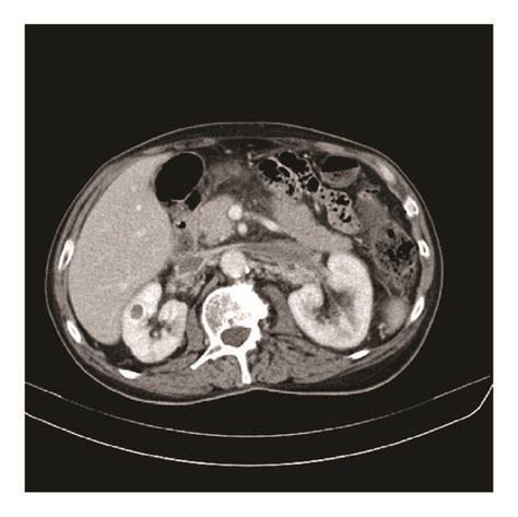 Ct Scan Cross Section Thrombosis Of The Left And Right Renal Veins And