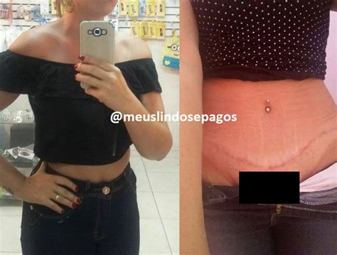 Meus Lindos E Pagos Arquivos Abdominoplastia Lipoaspira O