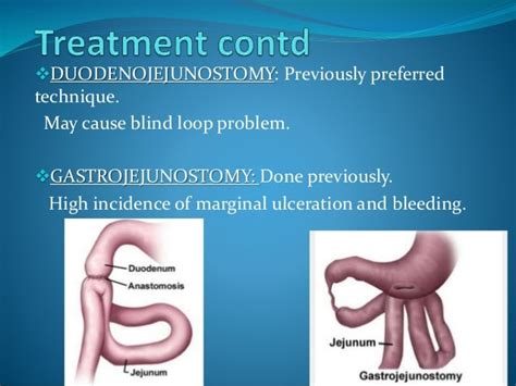 Duodenal Atresia