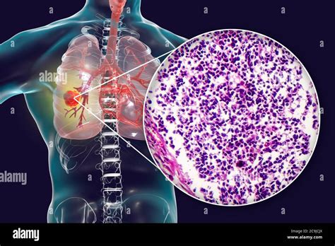 Cancer Du Poumon Illustration Informatique Et Micrographe L Ger Du