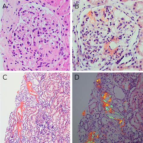 Systemic amyloidosis in a patient presenting with myopathy, peripheral