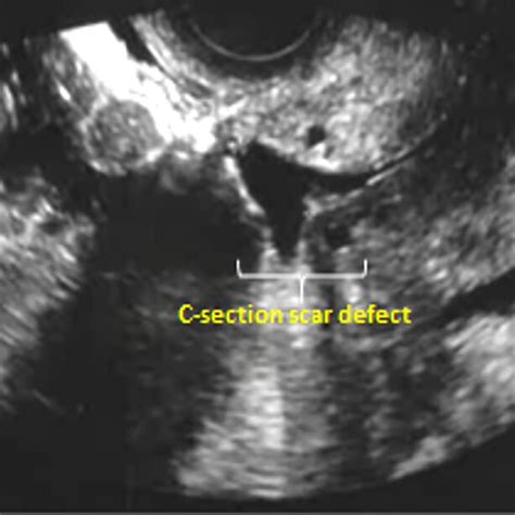 Transvaginal Ultrasound Examination Showing A C Section Scar Defect Download Scientific Diagram