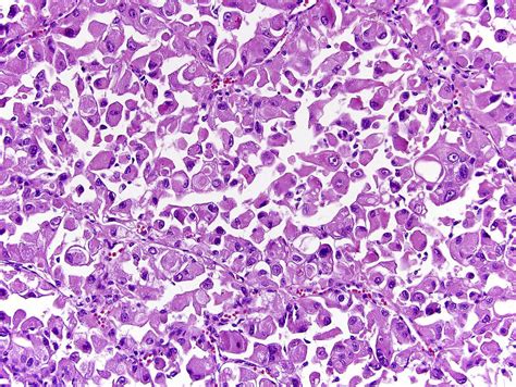 Pathology Outlines Rhabdoid Variant