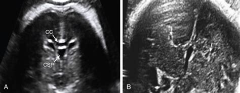 Cavum Septum Pellucidum Fetal Ultrasound